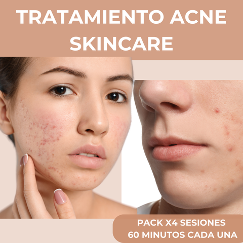 Acné Skincare: Tratamiento para adolescentes - Pack x 4