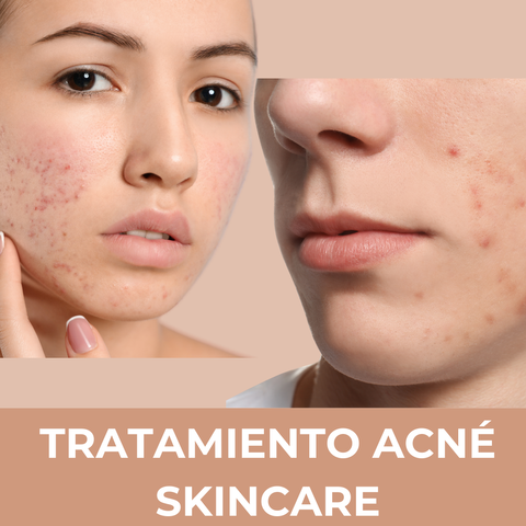 Tratamiento ANTIACNË