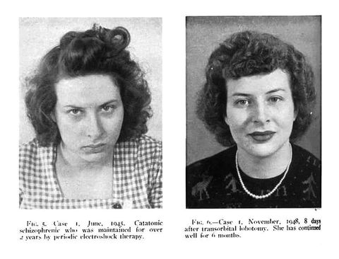 Lobotomía: el hielo en la mente – Walter J. Freeman y víctimas