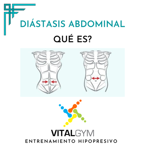 Diástasis Abdominal - Qué es?