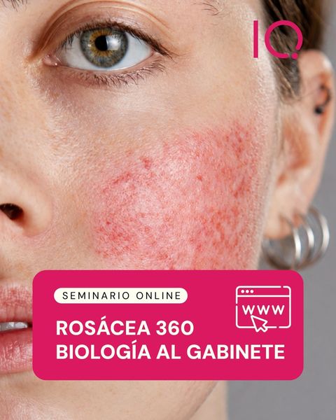 Seminario online: Rosácea 360°de la fisiología al gabinete