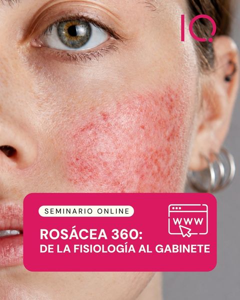 Seminario online: Rosácea 360°de la fisiología al gabinete