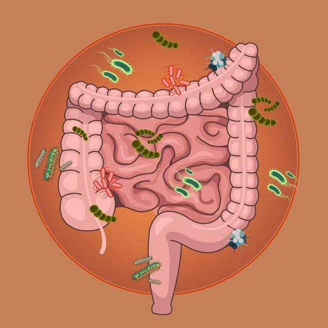 SIBO: La pandemia digestiva silenciosa y su tratamiento NATURAL INTEGRAL 