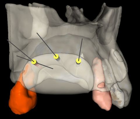 Barreras de Zirconio en Odontología: la nueva revolución en regeneración ósea