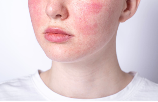 Rosácea y medicina china: cómo el drenaje facial puede armonizar tu piel desde adentro