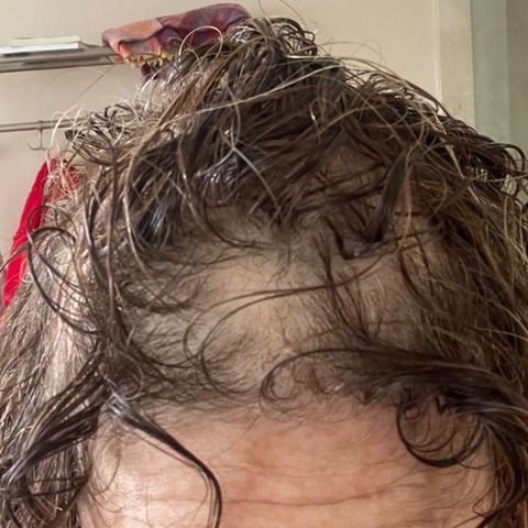 Alopecia Areata: Un caso de éxito en Centro EVE