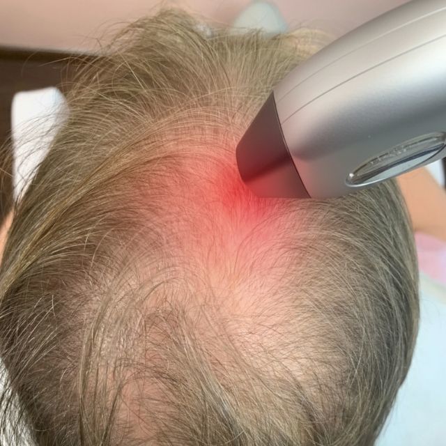 ¿Depilación Láser en el Cuero Cabelludo? Cómo el calor y los tintes debilitan tu folículo sin que lo notes