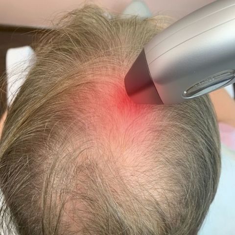 ¿Depilación Láser en el Cuero Cabelludo? Cómo el calor y los tintes debilitan tu folículo sin que lo notes