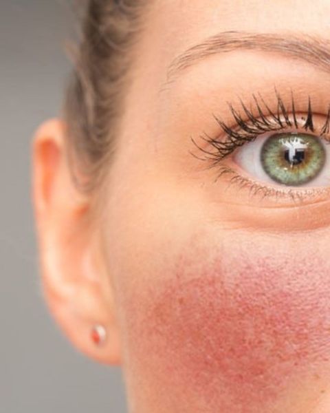  NO DISPONIBLE Masterclass Rosácea