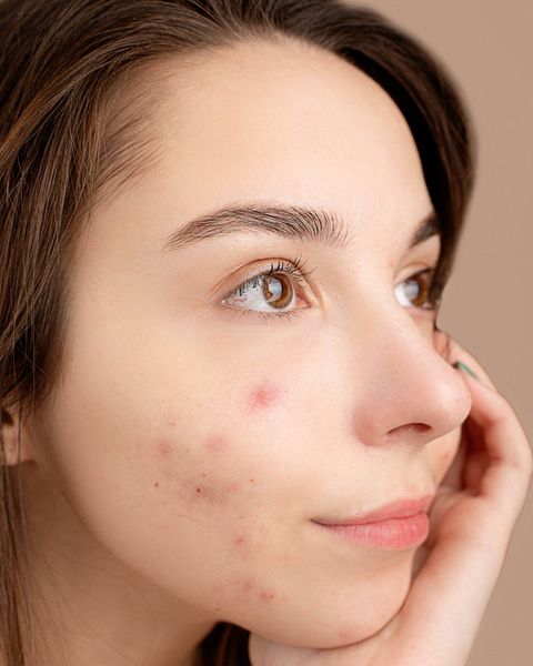  NO DISPONIBLE Masterclass Acné