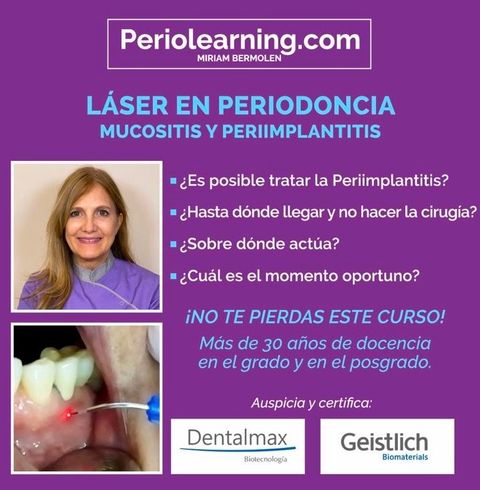 Laser en Periodoncia ¿es el fin de las curetas?