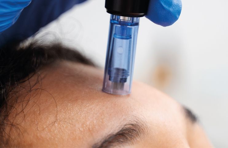 MICRONEEDLING FACIAL