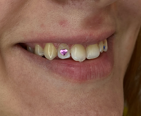 APLICACION GEMAS DENTALES