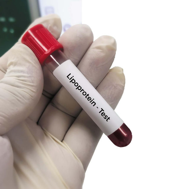 Lipoproteína(a): Actualización sobre Pruebas, Tratamiento y el Rol de la Suplementación